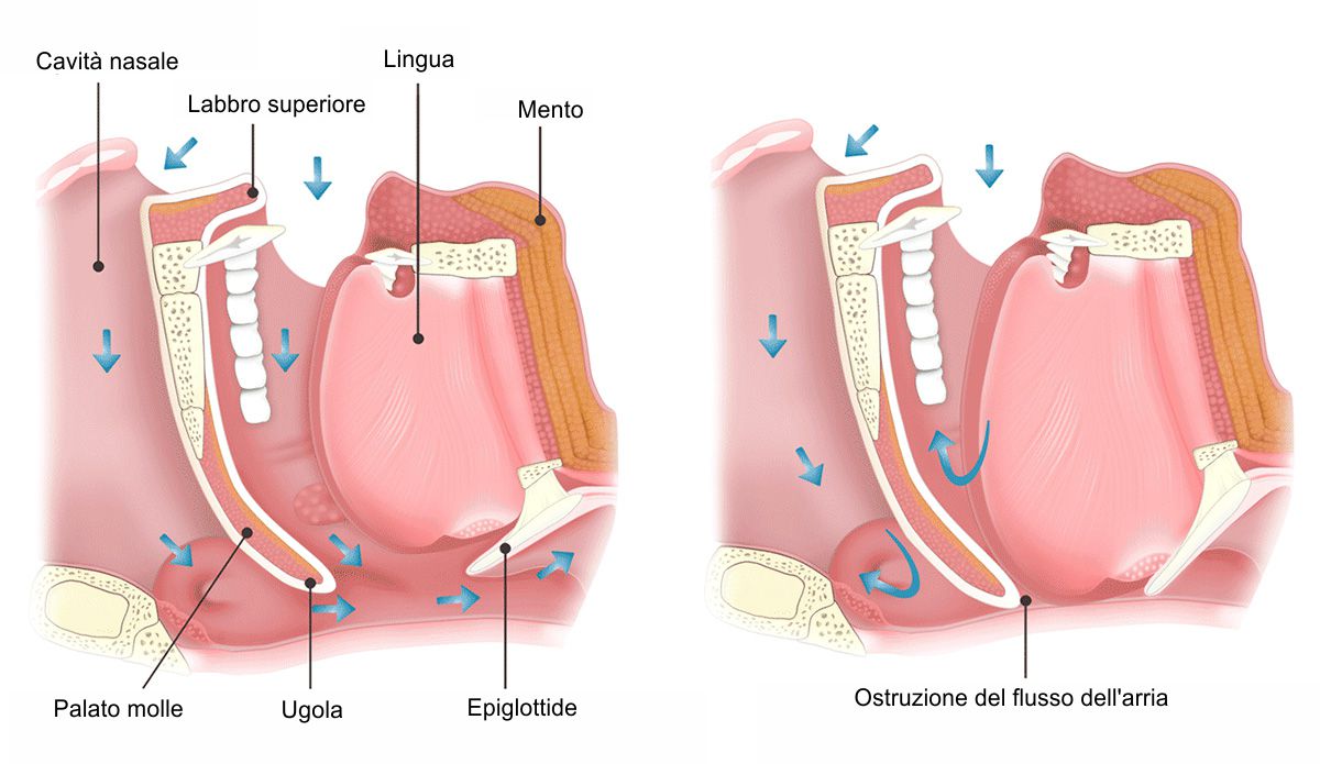 L' apnea notturna ostruisce il normale flusso dell'aria